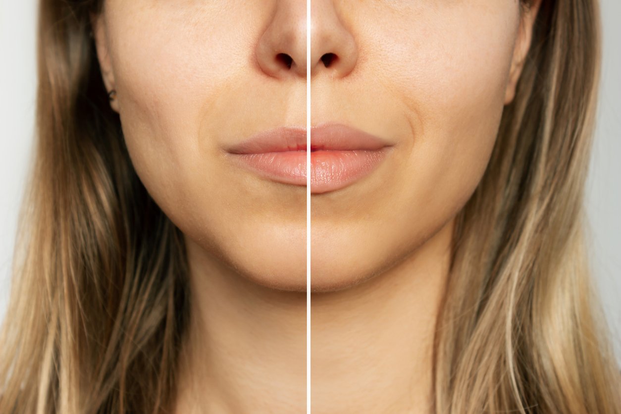 Before and after of woman with lip enhancement with dermal fillers. 