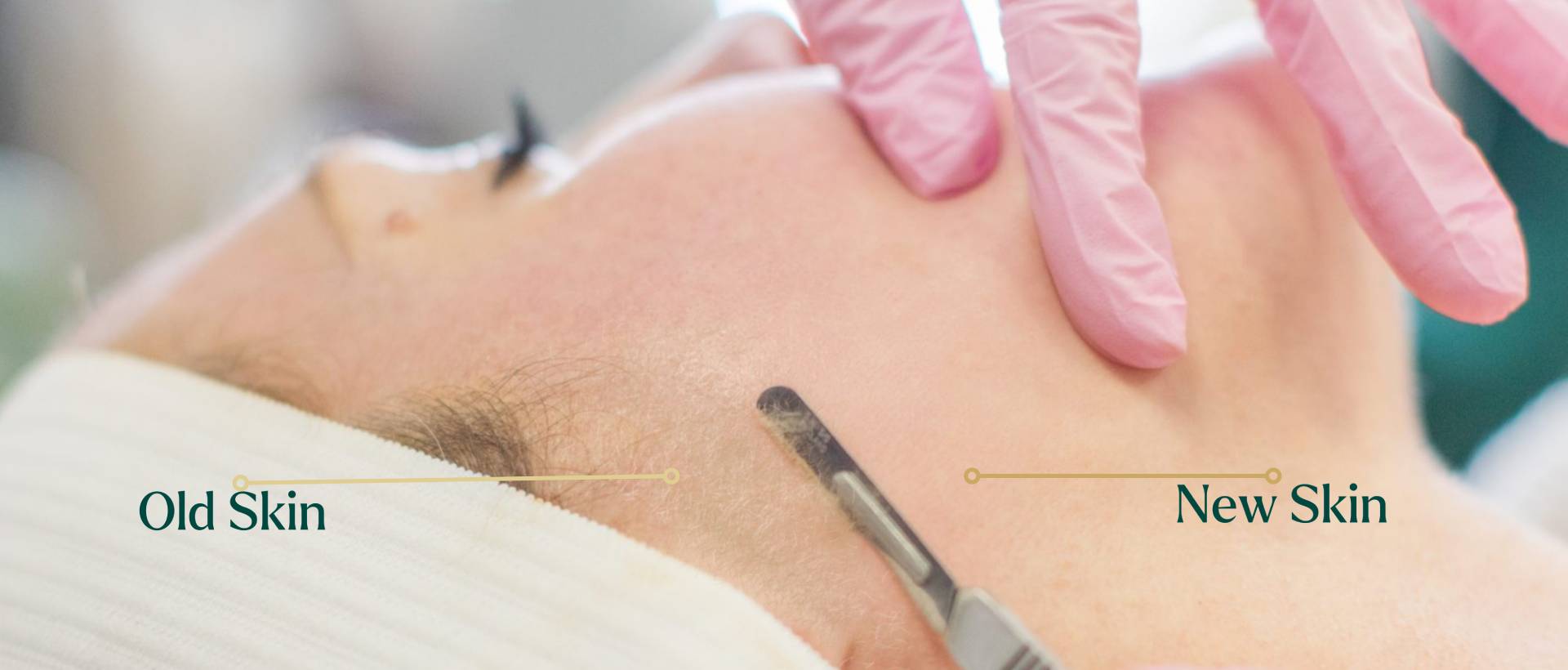 Before and after dermaplaning.