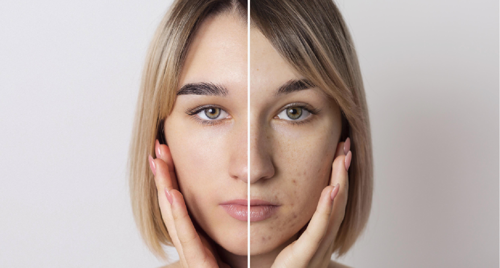 Before/After Microdermabrasion